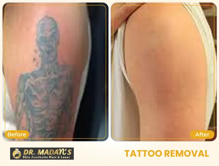 Tattoo removal before and after result 11 at Dr Madan Aesthetics